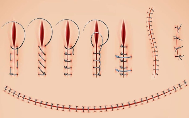 روش کشیدن بخیه در منزل 3 ث