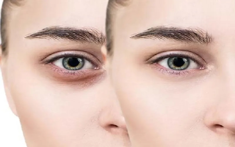 اندولیفت زیر چشم؛ درمان پف و تیرگی زیر چشم بدون جراحی 1 اندولیفت زیر چشم چیست