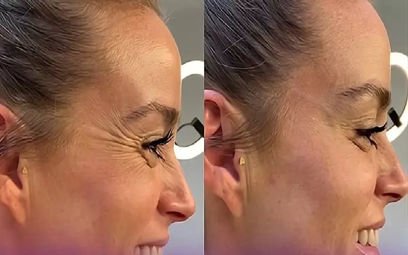 از چند سالگی باید بوتاکس کرد؟؛ همه چیز درباره بوتاکس صورت 1 از چند سالگی باید بوتاکس کرد؟؛ همه چیز درباره بوتاکس صورت