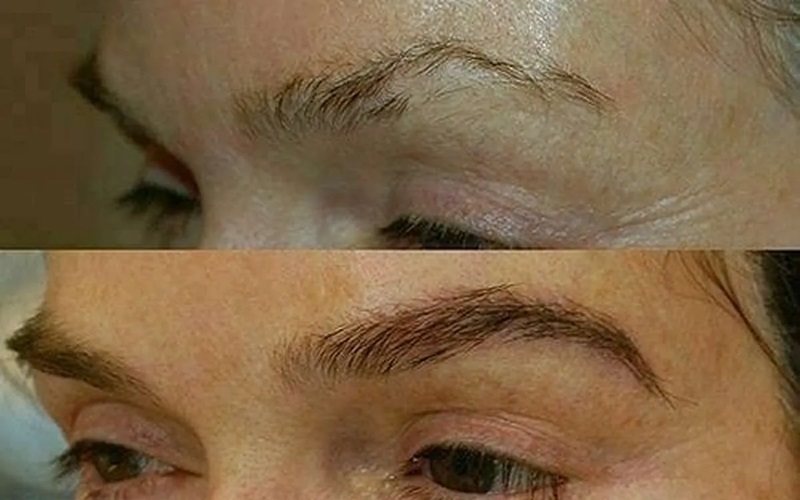 کاشت ابرو به روش بیوفیبر چیست و چگونه انجام میشود؟ 3 معایب و محدودیتهای کاشت ابرو به روش بیوفیبر