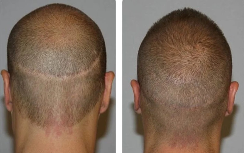 راهکارهای از بین بردن خط بخیه در کاشت مو 1 خط بخیه در کاشت مو چیست؟