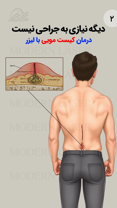 درمان کیست مویی با لیزر 4 حح