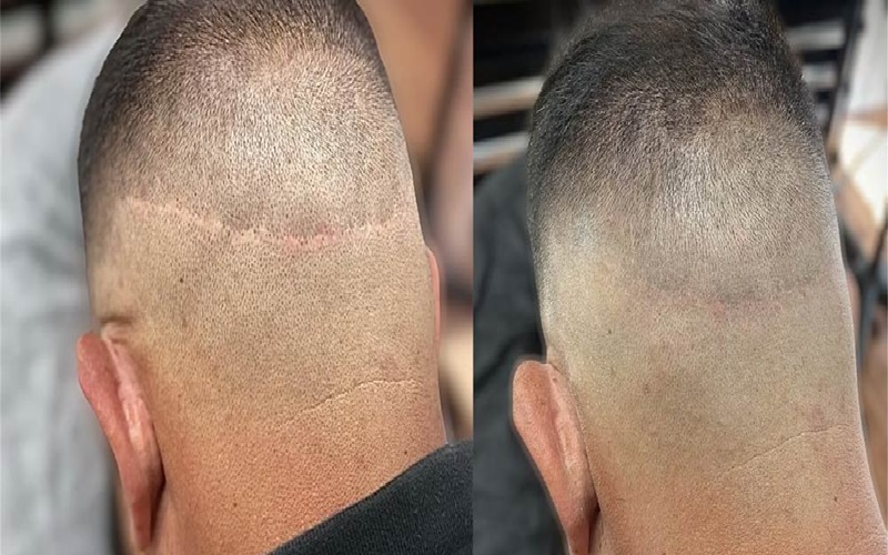 راهکارهای از بین بردن خط بخیه در کاشت مو 2 روشهای پیشگیری از ایجاد خط بخیه