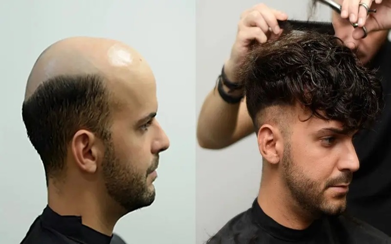 پروتز مو چیست و چه مواقعی میتوان از آن استفاده کرد؟ 2 کاربردهای پروتز مو