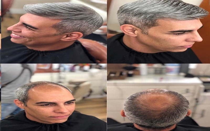 پروتز مو چیست و چه مواقعی میتوان از آن استفاده کرد؟ 3 محدودیتها و نکات مهم