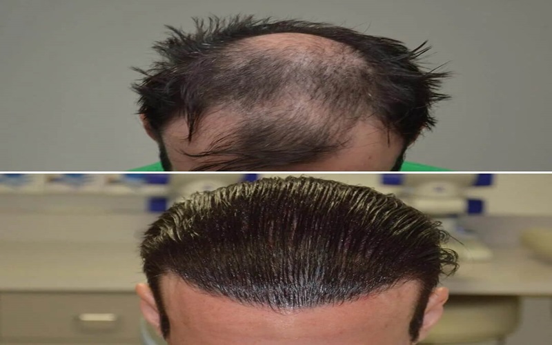 مقایسه کاشت مو و مزوتراپی: راهنمای جامع انتخاب روش مناسب 1 کاشت مو چیست؟