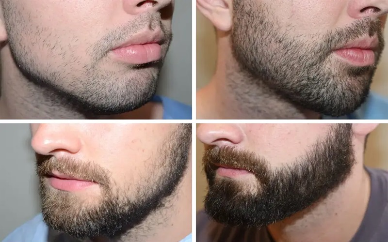 سن مناسب کاشت ریش و سبیل 3 مزایای رعایت سن مناسب