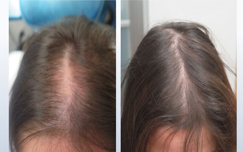 مقایسه کاشت مو و مزوتراپی: راهنمای جامع انتخاب روش مناسب 2 مزوتراپی چیست؟