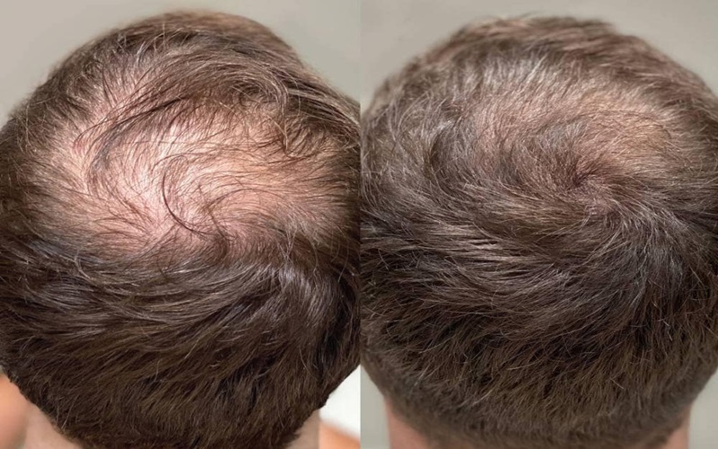 مقایسه کاشت مو و مزوتراپی: راهنمای جامع انتخاب روش مناسب 3 مقایسه کاشت مو و مزوتراپی