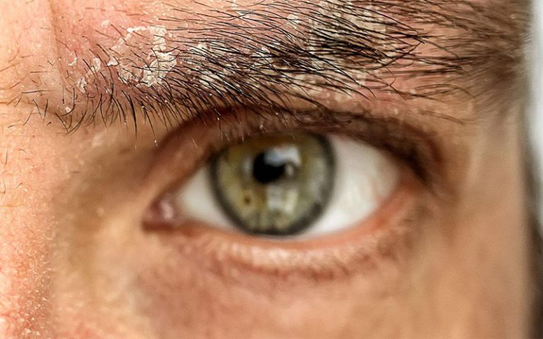 پوسته پوسته شدن ابروها بعد از کاشت