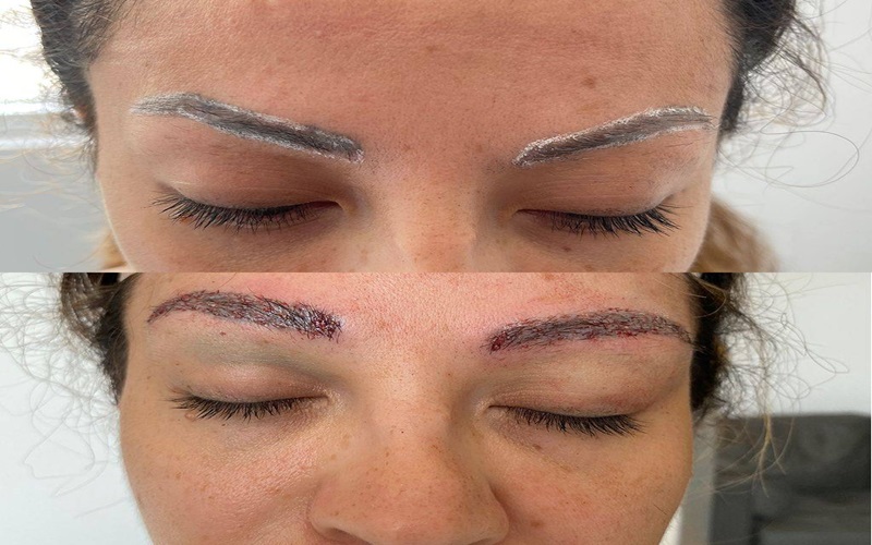 علت پوستهپوسته شدن ابروها بعد از کاشت ابروی طبیعی | راهنمای کامل 2 مدت زمان پوسته پوسته شدن ابروها بعد از کاشت