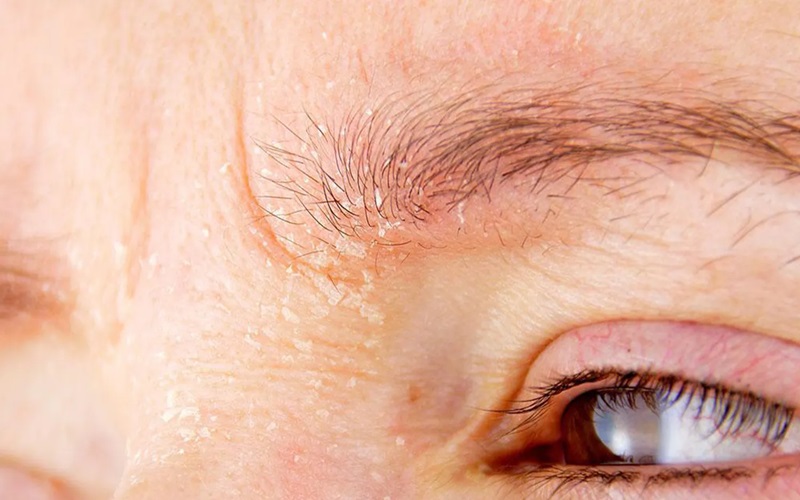 علت پوستهپوسته شدن ابروها بعد از کاشت ابروی طبیعی | راهنمای کامل 3 نکات تکمیلی برای بهبود روند بهبودی