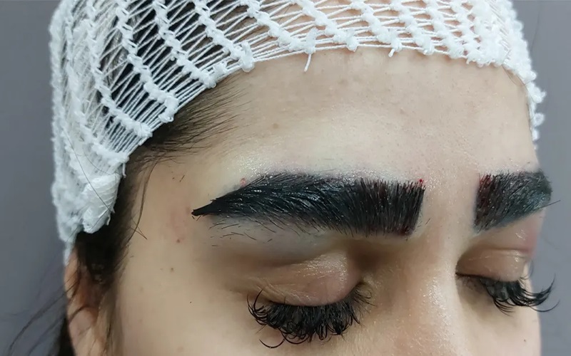 علت عفونت بعد از کاشت ابرو: نکاتی که باید بدانید 2 دلایل ایجاد عفونت بعد از کاشت ابرو