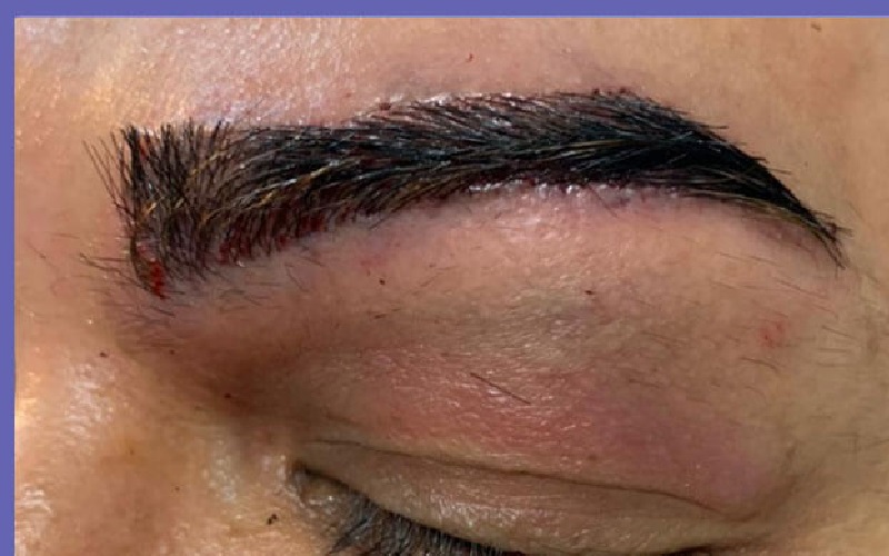 علت عفونت بعد از کاشت ابرو: نکاتی که باید بدانید 3 پیشگیری از عفونت بعد از کاشت ابرو