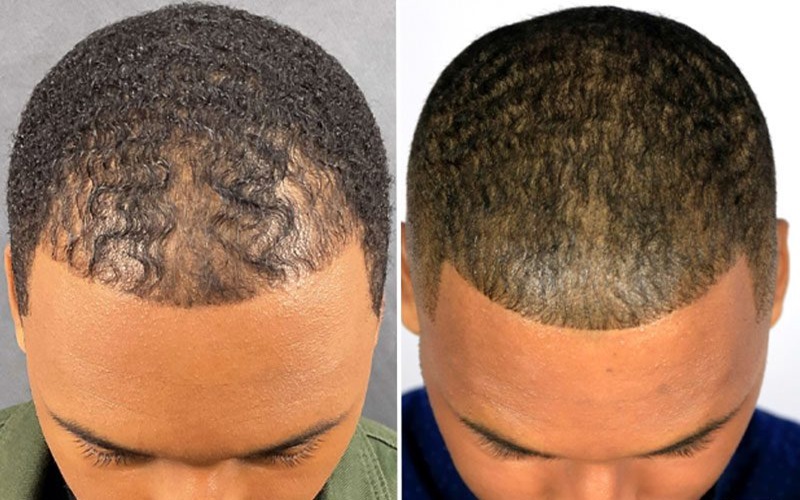 ۱۰ تصور رایج اشتباه در مورد کاشت مو 2 دوره نقاهت کاشت مو طولانی است