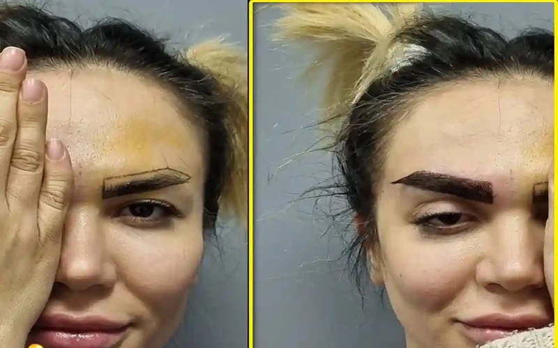 کاشت ابرو به روش FUE و مقایسه با دیگر روشها 2 کاشت ابرو به روش FUE چیست؟