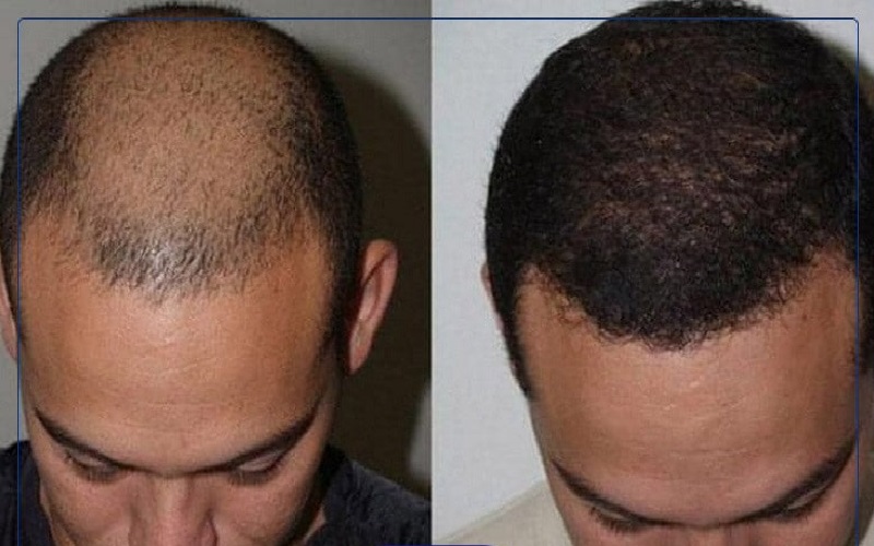 آیا کاشت مو با استفاده از بانک موی افراد دیگر امکان پذیر است؟ 1 کاشت مو با استفاده از بانک موی افراد دیگر چیست؟