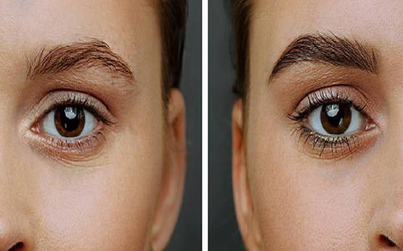 کاشت ابرو بدون جراحی چیست و چگونه انجام میشود؟ 1 کاشت ابرو بدون جراحی چیست؟