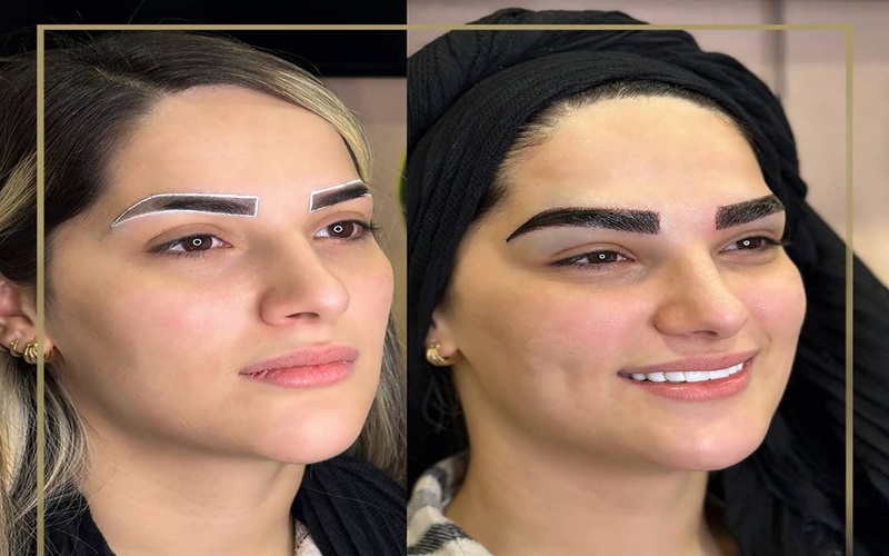 کاشت ابرو به روش میکروگرافت چیست؟ + هزینه و مزایا 3 نکات مهم قبل و بعد از کاشت ابرو به روش میکروگرافت