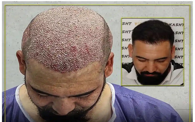 کاشت مو به روش سلولهای بنیادی 3 مراقبتهای قبل و بعد از کاشت مو