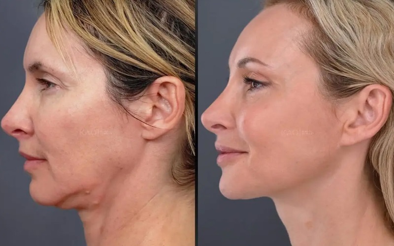 روشهای لیفت پوست بدون جراحی 2 چرا لیفت پوست بدون جراحی محبوب است؟