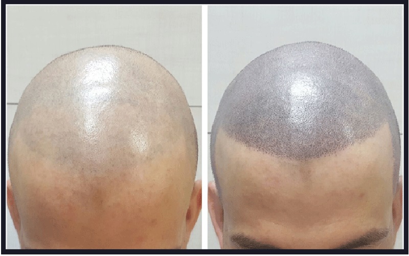 ۱۰ تصور رایج اشتباه در مورد کاشت مو 3 موهای کاشتهشده نیاز به مراقبت خاص ندارند