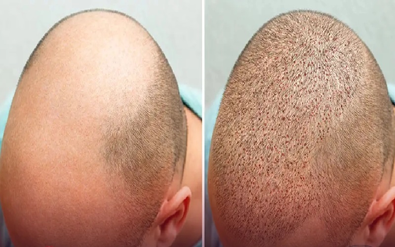 مراقبت از موی کاشته شده؛ چگونه از موهای کاشته شده خود مراقبت کنیم؟ 2 نکات کلیدی مراقبت از موی کاشته شده