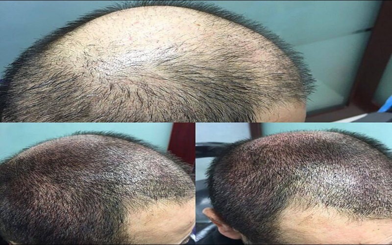 مقایسه کاشت مو و میکرواسکالپ سر 3 مراقبتها و نکات پس از درمان