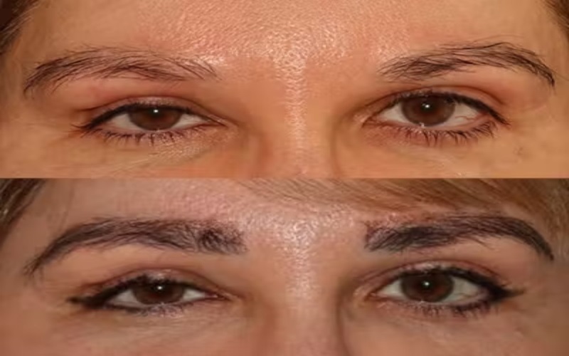 چطور میتوان از عوارض بعد از کاشت ابرو جلوگیری کرد؟ | راهنمای کامل مراقبتها 3 روشهای جلوگیری از عوارض بعد از کاشت ابرو