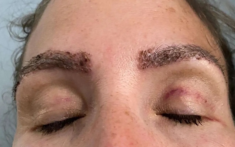 چطور میتوان از عوارض بعد از کاشت ابرو جلوگیری کرد؟ | راهنمای کامل مراقبتها 2 روشهای جلوگیری از عوارض بعد از کاشت ابرو