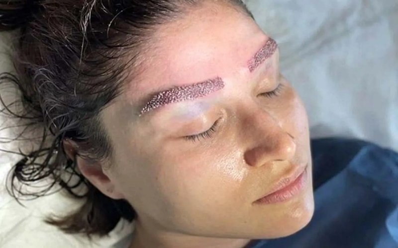 دلایل و درمان ورم بعد از کاشت ابرو | راهنمای کامل مراقبتها 1 ورم بعد از کاشت ابرو چیست؟