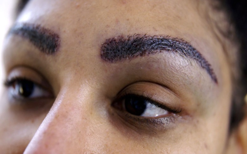 دلایل و درمان ورم بعد از کاشت ابرو | راهنمای کامل مراقبتها 2 نشانهها و علائم ورم بعد از کاشت ابرو