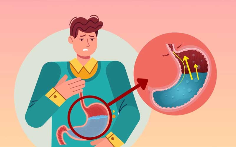 تغییرات رژیم غذایی برای کنترل ریفلاکس اسید معده 3 برنامه غذایی نمونه برای کاهش ریفلاکس