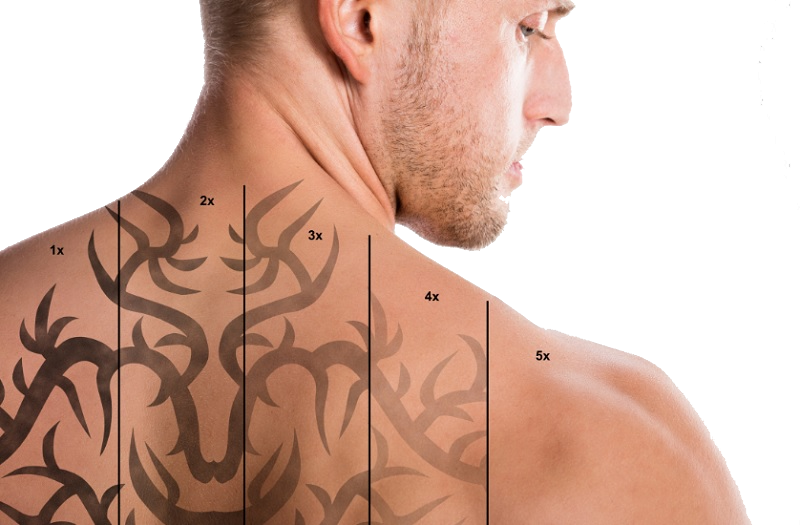 عوارض تتو چیست؟ ۱۱ خطری که پیش از خالکوبی باید بدانید! 1 چرا تتو میتواند خطرناک باشد؟ (ارتباط تتو با عفونت)