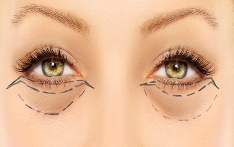 انواع مدل های بلفاروپلاستی: راهنمای کامل روشهای جراحی ترمیم پلک 2 جراحی بلفاروپلاستی تحتانی (پایینی)