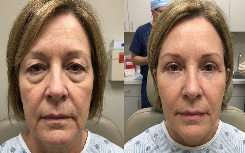 انواع مدل های بلفاروپلاستی: راهنمای کامل روشهای جراحی ترمیم پلک 3 بلفاروپلاستی ترکیبی: ترکیب جراحی پلک فوقانی و تحتانی