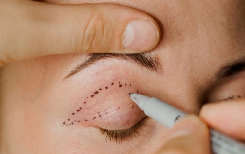 بهترین روش درمان افتادگی پلک کدام است؟ مقایسه جامع جراحی و غیرجراحی 2 روشهای جراحی درمان افتادگی پلک: راه حل های دائمی و قطعی (بهترین گزینه در موارد شدید)