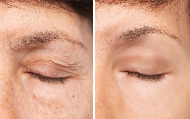 بلفاروپلاستی با لیزر: راهنمای جامع کاربردها، مزایا و نکات مراقبتی 1 بلفاروپلاستی با لیزر چیست و چگونه انجام میشود؟