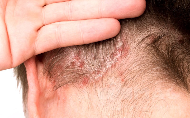 کاشت مو برای بیماران پسوریازیس پوست سر 2 کاشت مو برای بیماران پسوریازیس