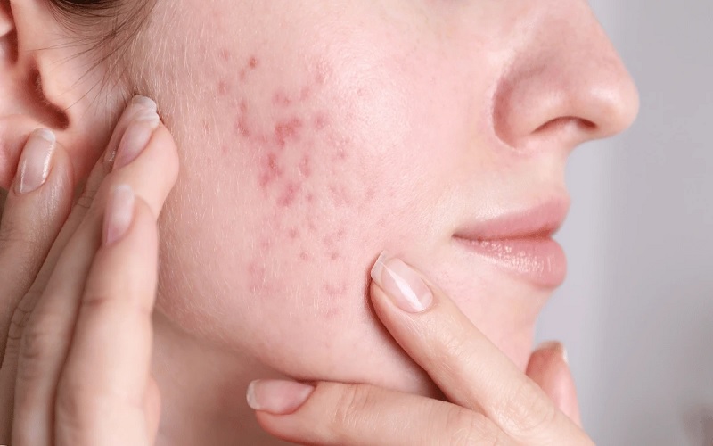 معرفی جامع انواع اسکار پوستی و موثرترین روشهای درمان آن 1 اا 11