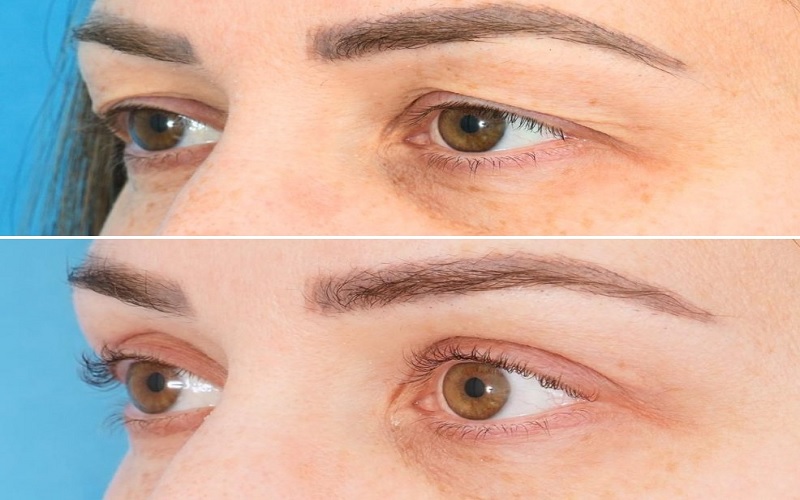 بلفاروپلاستی با لیزر: راهنمای جامع کاربردها، مزایا و نکات مراقبتی 2 مزایای بلفاروپلاستی با لیزر؛ چرا بسیاری این روش را انتخاب میکنند؟