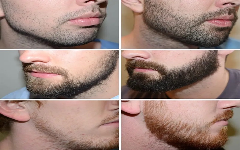 مزایا و معایب کاشت ریش؛ راهنمای جامع برای تصمیمگیری 2 معایب کاشت ریش