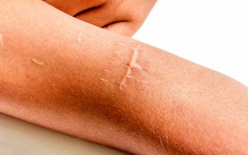 از بین بردن جای بخیه با جراحی پلاستیک: پاسخ کامل و راهنمای جامع 1 اسکار ناشی از بخیه