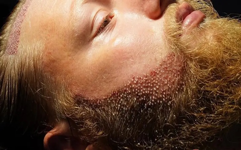 مزایا و معایب کاشت ریش؛ راهنمای جامع برای تصمیمگیری 3 روشهای کاشت ریش