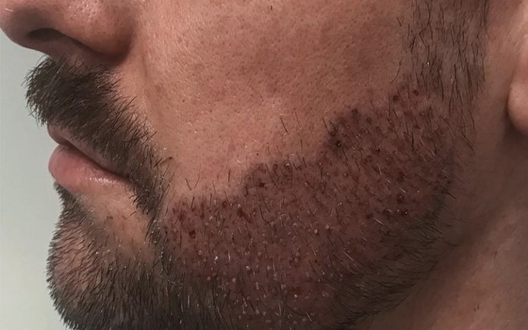 مزایا و معایب کاشت ریش