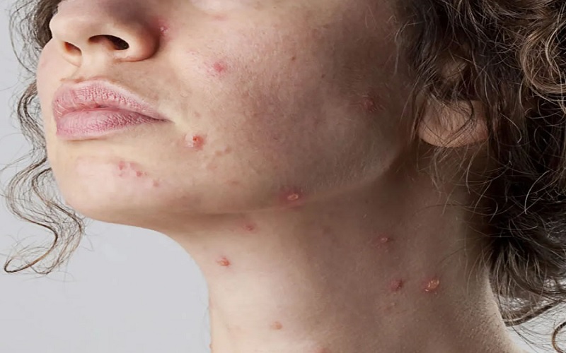 معرفی جامع انواع اسکار پوستی و موثرترین روشهای درمان آن 3 اااا 8