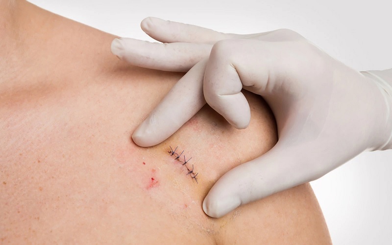 از بین بردن جای بخیه با جراحی پلاستیک: پاسخ کامل و راهنمای جامع 2 جراحی پلاستیک جای بخیه