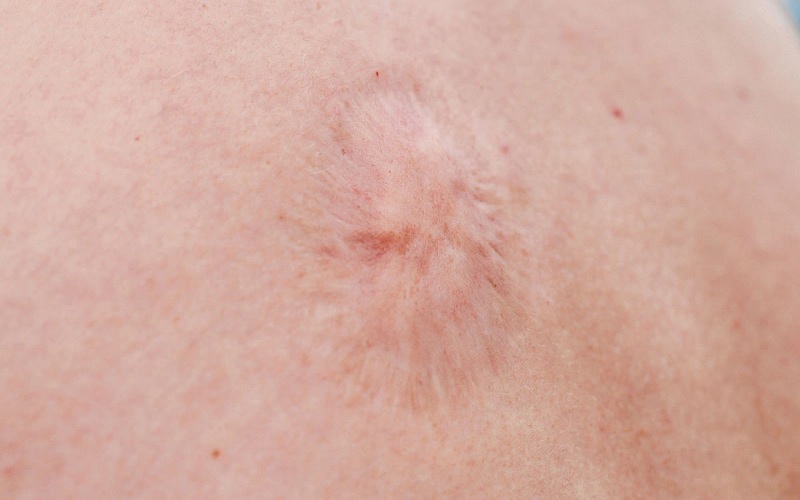 معرفی جامع انواع اسکار پوستی و موثرترین روشهای درمان آن 4 ااااا 6