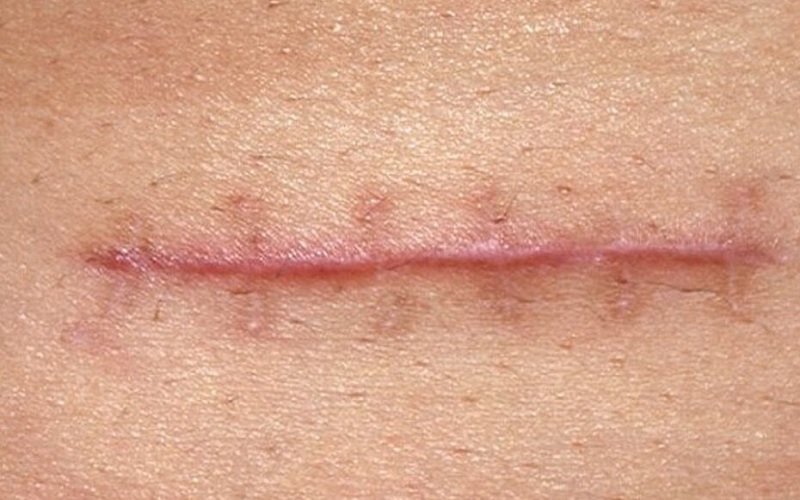 از بین بردن جای بخیه با جراحی پلاستیک: پاسخ کامل و راهنمای جامع 3 ااااا 7