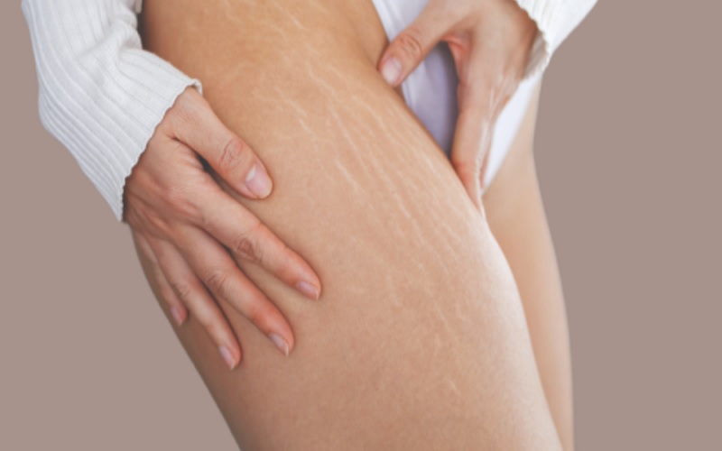 معرفی جامع انواع اسکار پوستی و موثرترین روشهای درمان آن 5 اااااا 2